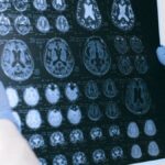 11-fatores-de-risco-que-ajudam-a-prever-chances-de-demencia