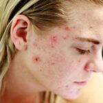bacterias-da-pele-sao-usadas-em-novo-tratamento-contra-acne