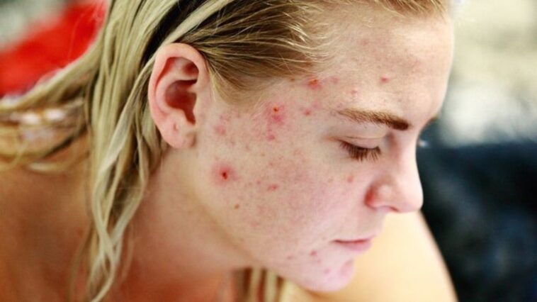 bacterias-da-pele-sao-usadas-em-novo-tratamento-contra-acne